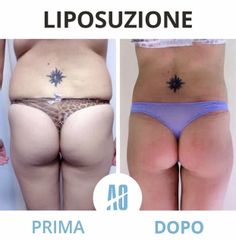 Liposuzione - Dott. Orlandi Alberto
