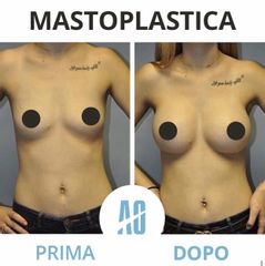 Mastoplastica additiva - Dott. Orlandi Alberto