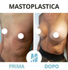 Mastoplastica additiva - Dott. Orlandi Alberto