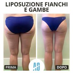 Liposuzione - Dott. Orlandi Alberto