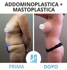 Addominoplastica - Dott. Orlandi Alberto