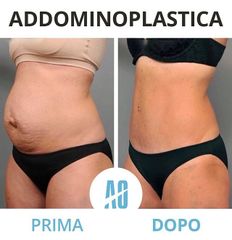 Addominoplastica - Dott. Orlandi Alberto