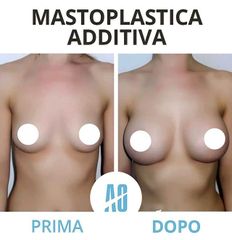 Mastoplastica additiva - Dott. Orlandi Alberto