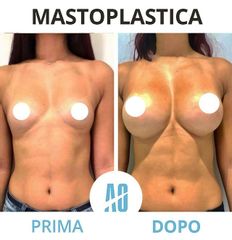 Mastoplastica additiva - Dott. Orlandi Alberto
