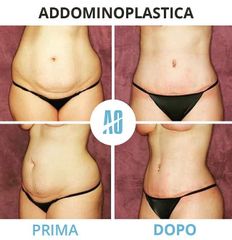 Addominoplastica - Dott. Orlandi Alberto