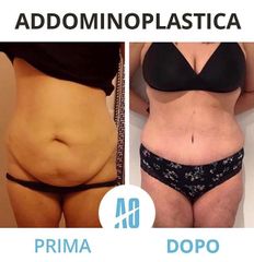 Addominoplastica - Dott. Orlandi Alberto