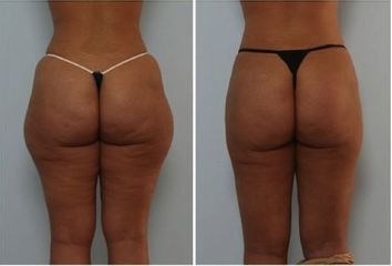 Liposcultura prima e dopo