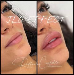 Filler labbra - Dott. Raffaele Castaldo