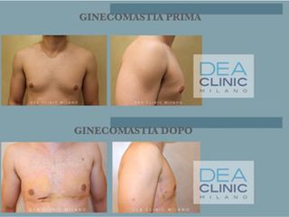 Ginecomastia prima e dopo