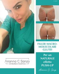 Dott.ssa Arianna C. Sanzo Filler Glutei