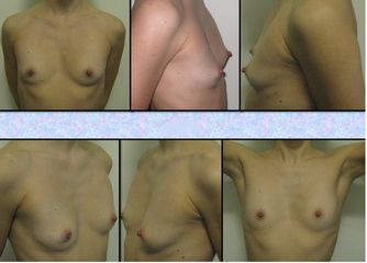 Mastoplastica additiva sottomuscolare dual plane protesi anatomiche PRE INTERVENTO
