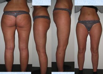 Lipoaspirazione ultrasonica dual fianchi-trocanteri-glutei-int-coscia-ginocchio