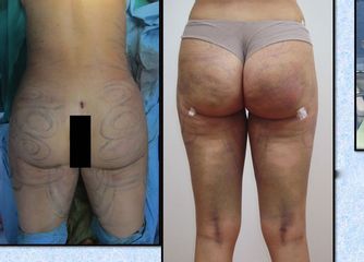 Revisione di lipoaspirazione ultrasonica