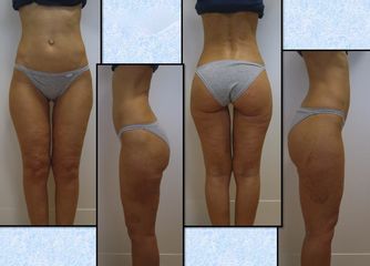 Lipoaspirazione ultrasonica post