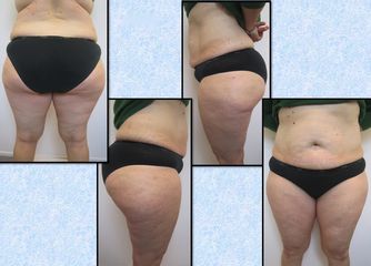 Lipoaspirazione ultrasonica pre