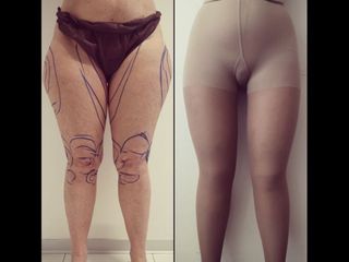 Liposuzione - Dott. Alessandro Nube
