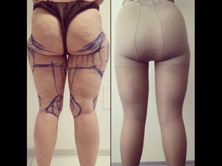 Liposuzione - Dott. Alessandro Nube