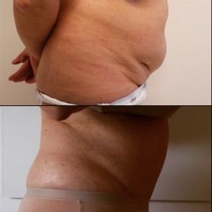 Liposuzione - Dott. Alessandro Nube