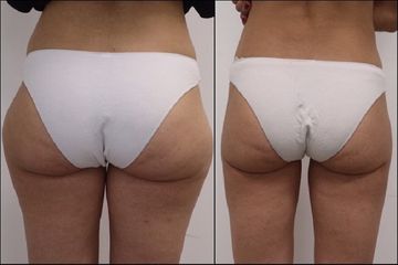 Liposuzione - Dott. Alessandro Nube