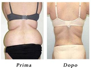 Liposuzione e addominoplastica