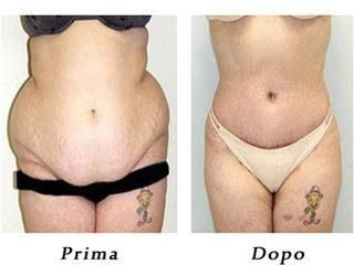 Liposuzione e addominoplastica