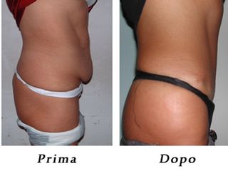 Addominoplastica prima e dopo