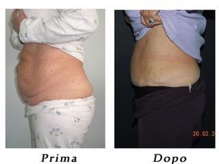 Addominoplastica prima e dopo