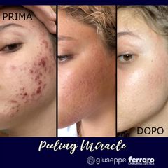 Miracle Peeling - Prof. Giuseppe A. Ferraro