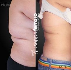 Liposuzione - Prof. Giuseppe A. Ferraro