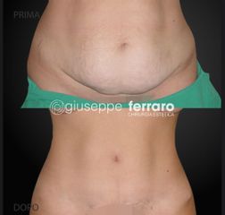 Liposuzione - Prof. Giuseppe A. Ferraro