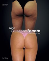 Gluteoplastica - Prof. Giuseppe A. Ferraro