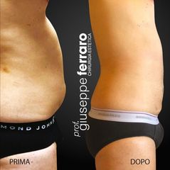 Liposuzione - Prof. Giuseppe A. Ferraro