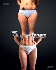 Liposuzione - Prof. Giuseppe A. Ferraro