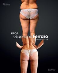 Liposuzione - Prof. Giuseppe A. Ferraro