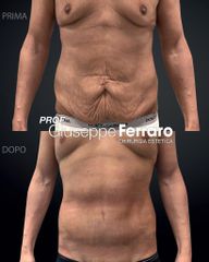 Addominoplastica - Prof. Giuseppe A. Ferraro