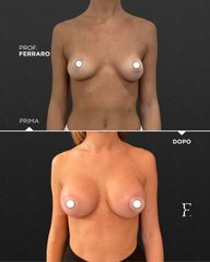 mastoplastica additiva - Prof. Giuseppe A. Ferraro