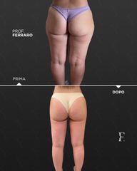 Liposuzione - Prof. Giuseppe A. Ferraro