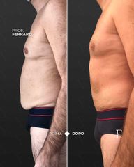 Liposuzione - Prof. Giuseppe A. Ferraro