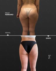 Gluteoplastica - Prof. Giuseppe A. Ferraro