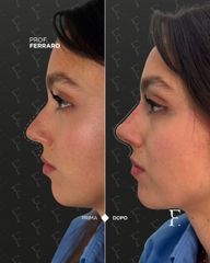 Prof. Giuseppe A. Ferraro Rinoplastica