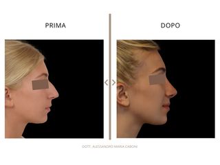 Dott. Alessandro Maria Caboni Rinoplastica e mentoplastica