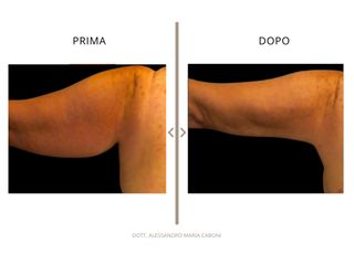 Dott. Alessandro Maria Caboni lifting braccia