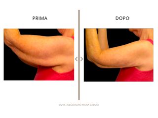 Dott. Alessandro Maria Caboni Lifting dei tessuti cutanei con radiofrequenza assistita bodytite