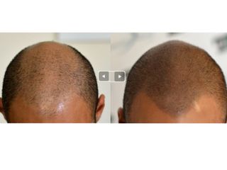 Tricopigmentazione capelli prima e dopo