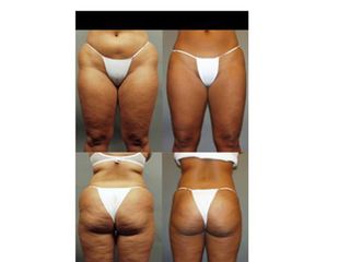 Liposcultura prima e dopo