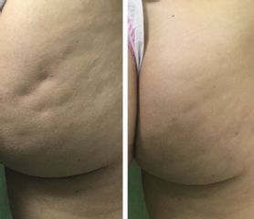 Cellulite - Dr Benoit Menye