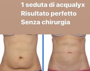 Intralipoterapia - Dr Benoit Menye