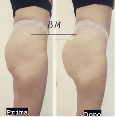 Gluteoplastica - Dr Benoit Menye