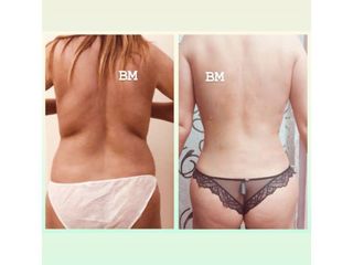 Liposuzione - Dr Benoit Menye