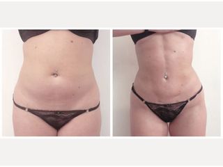 Liposuzione - Dr Benoit Menye